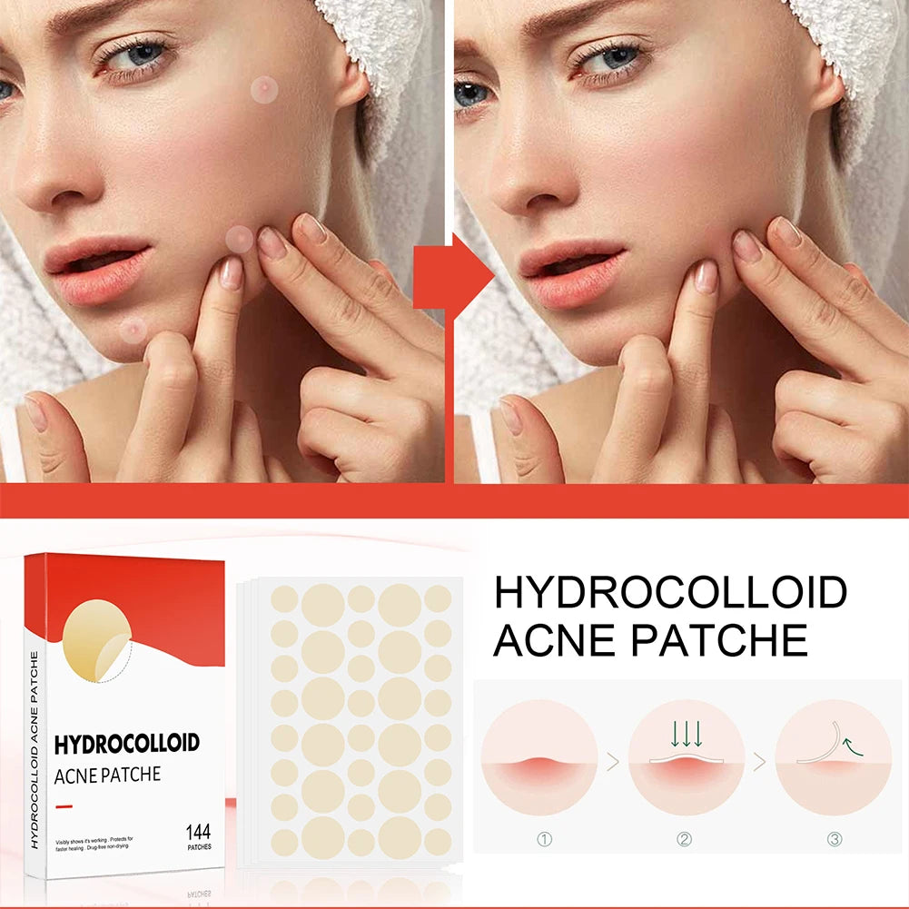 Acne Pimple Healing Spot Patches — 144pc Invisible Pimple Stickers for Men & Women