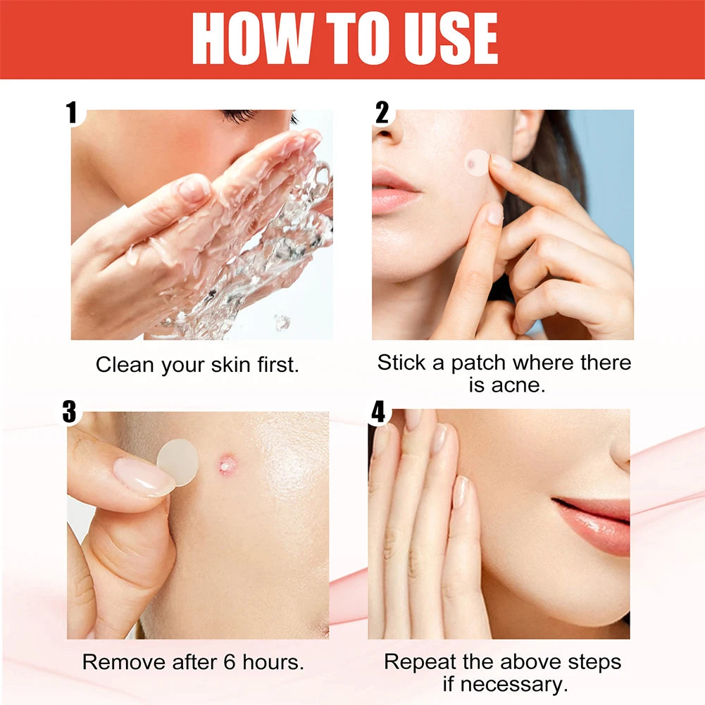 Acne Pimple Healing Spot Patches — 144pc Invisible Pimple Stickers for Men & Women